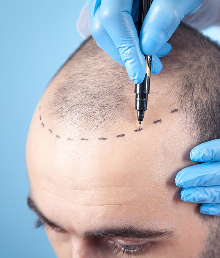 Hair Transplants